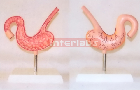 DISEASE STOMACH MODEL WITH DESCRIPTION PLATE